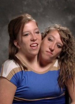 连体姐妹花艾比和布列塔尼