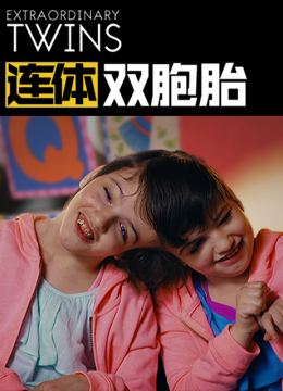 连体双胞胎